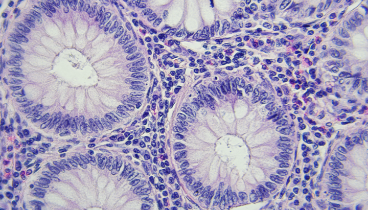 Colon cancer microscopic photography