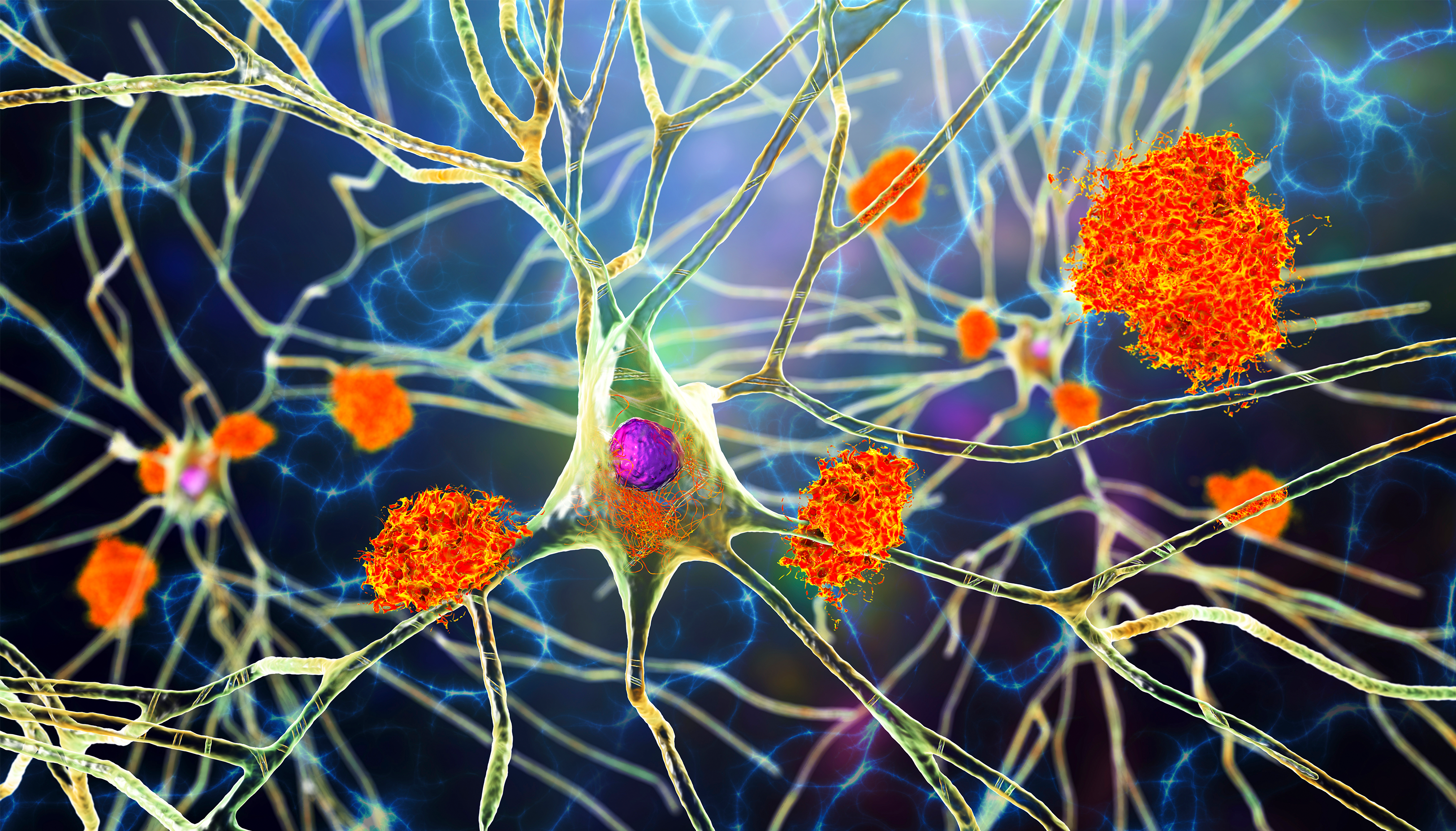 Neurons in Alzheimer's Disease